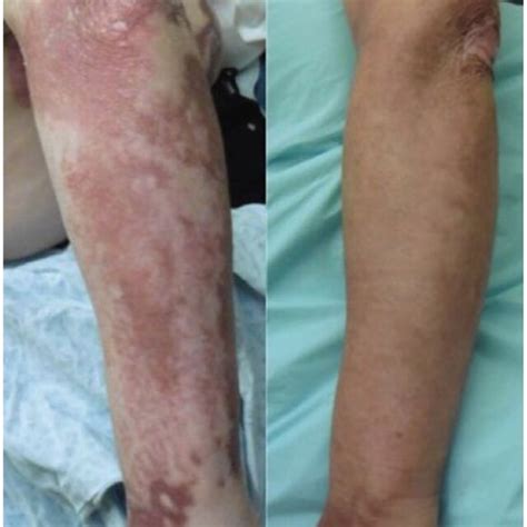 A Burn Scars On The Bilateral Lower Extremities Before Treatment B