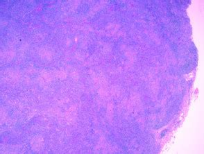 This lymphoma generally develops in the small intestine or colon. Angioimmunoblastic T-cell lymphoma | DermNet NZ