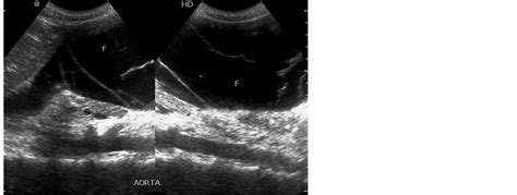 Abdominal Sonographic Findings In Severely Immunosuppressed Human