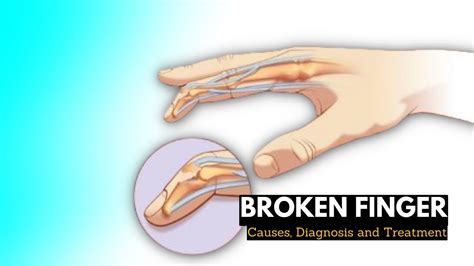 broken finger causes signs and symptoms diagnosis and treatment youtube