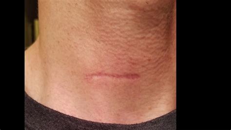 1 Year Cervical Disk Surgery Neck Scar Healing Timelapse Youtube