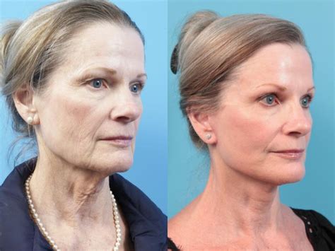 Facelift Before And After Pictures Case 19 West Des Moines Ia Koch
