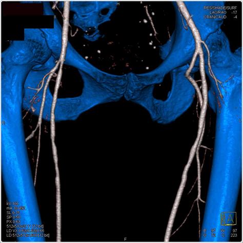 Popliteal Artery Aneurysm Vascular Case Studies Ctisus Ct Scanning