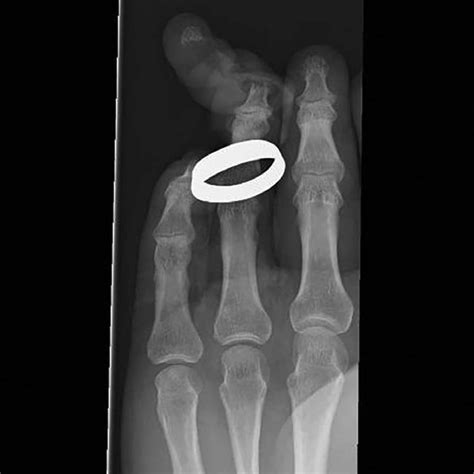 Anterior Posterior Radiograph Of Ring Avulsion Revealing A Distal Tuft