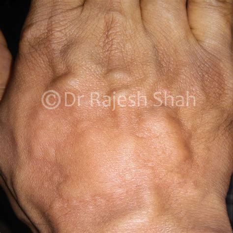 Urticaria Case Photos Urticaria On Different Parts Of The Body