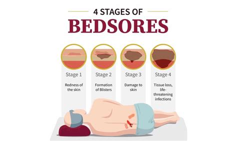 The Different Stages Of Bedsores