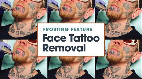 Frosting Feature Face Tattoo Removal Removery Youtube
