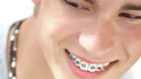Without insurance, 2014 expenses for traditional metal braces (frequently advised) ranged from $3,000 to $7,500 according to patient reports, however the overall cost differs by state, according to the journal of clinical orthodontics. #OremDentist