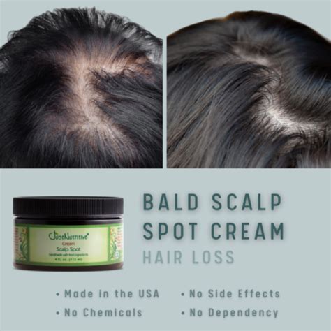 Bald Scalp Spot Cream Bald Spot Treatment Ebay