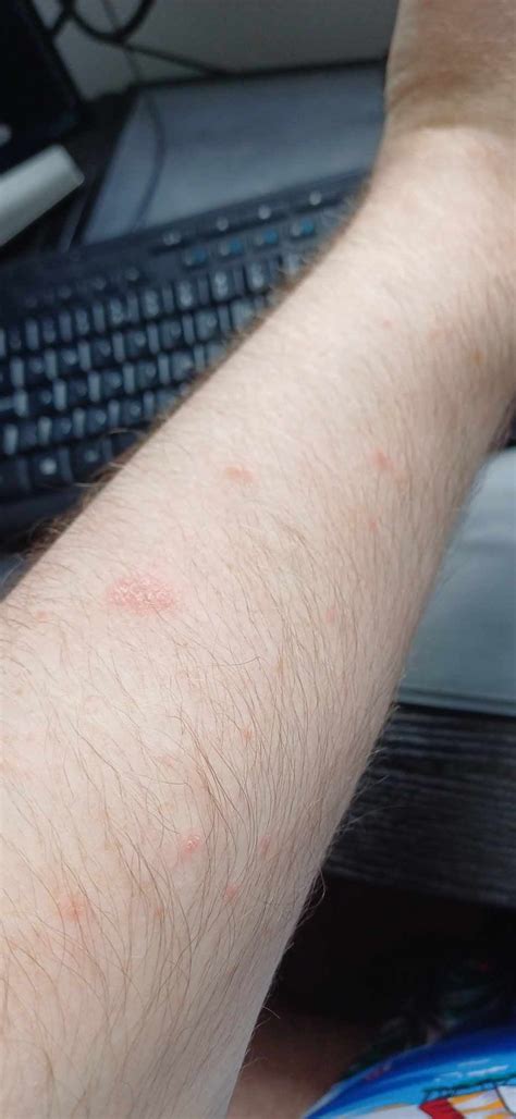 Red Scaly Patches And Smaller Red Bumps Suddenly Appearing On Arms