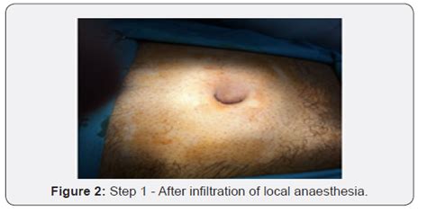 Comprehensive Outcome Of Repair Of Small Paraumbilical Hernias By Onlay