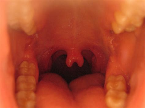Forkedbifid Uvula I Have A Forked Uvula Its Fun Simon P Flickr