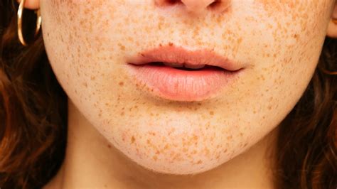 Uncovering The Meaning And Treatment Of Lip Freckles Justinboey