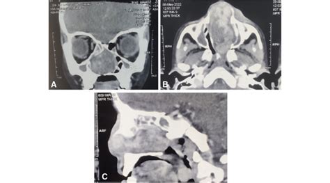 A C Computed Tomography Scans Of Nose And Paranasal Sinuses At