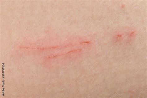 Scratch Marks On Skin Surface Cause By Sharp Fingernails Scratching An