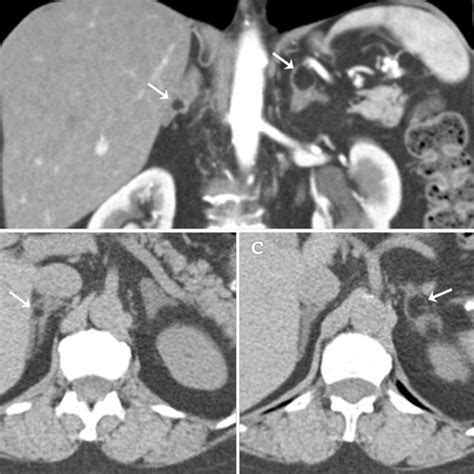 55 Year Old Woman With Renal Cell Carcinoma And Bilateral Adrenal