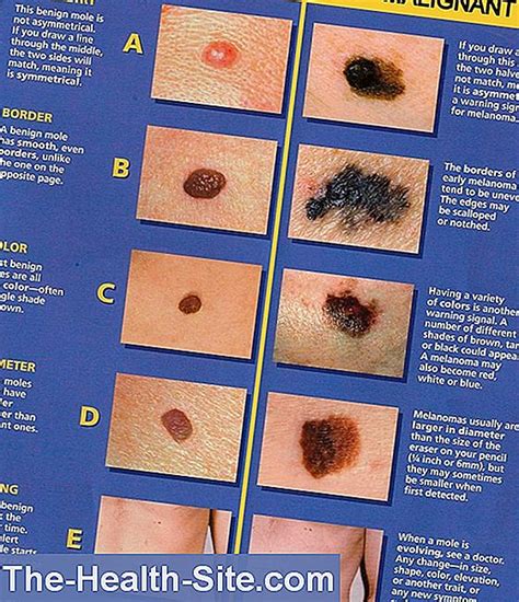 Abcde Rule Skin Cancer On The Trail 💊 Scientific Practical Medical
