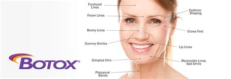 After getting a botox treatment, most people see results in less than a week. Botox® Cosmetic Boston | Anti-Wrinkle Injections Wellesley ...