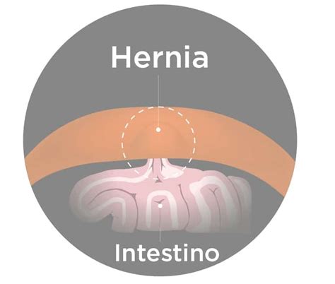 Hernia Inguinal Síntomas Y Tratamiento • Portal De Salud
