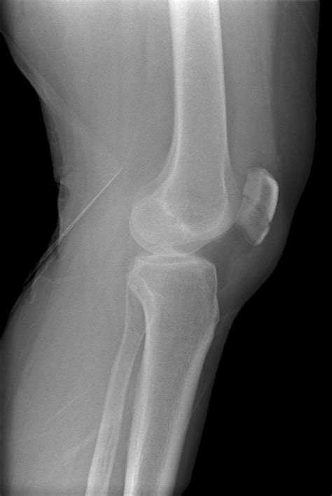 Broken Knee X Ray Photograph By Du Cane Medical Imaging Ltd Fine Art