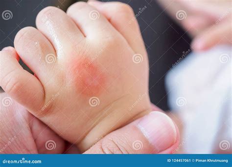 Baby Hand With Skin Rash And Allergy With Red Spot Stock Image Image