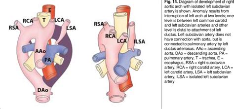 Diagram Of Development Of Right Aortic Arch With Isolated Left