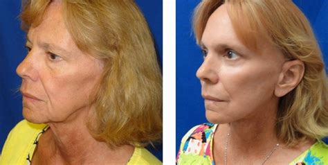 Facelift Before And After Pictures Orlando Fl Ymd Eye And Face