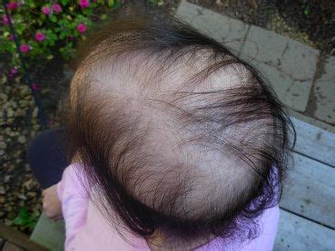 Chemotherapy Hair Loss Chemo Hair Loss Hair Due Her Hair Mastectomy