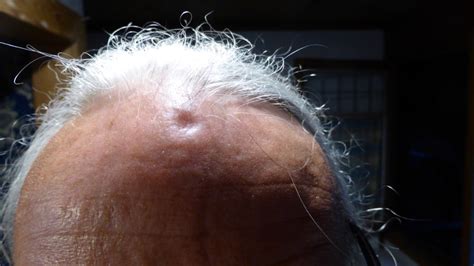 Dent In Head Causes And When To See A Doctor Vlrengbr