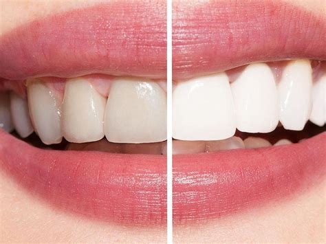What Is Home Bleaching And Is It Good Bello Dental Associates