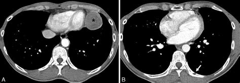 Follow Up Contrast Enhanced Chest Ct Scan 4 Months After The