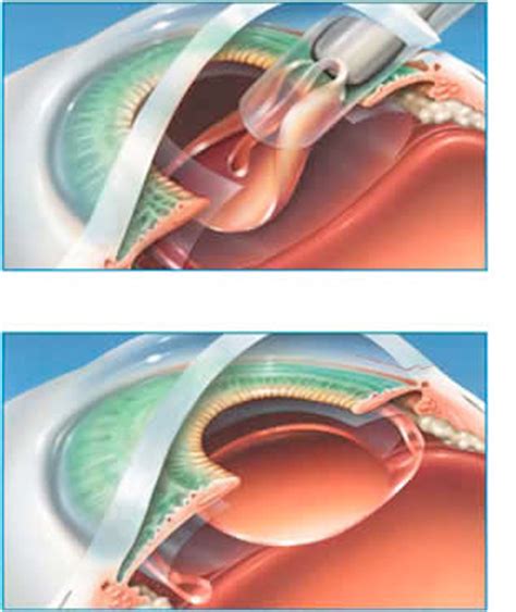Recent data has confirmed that the complication rate with lasik eye surgery is less than 1% and rarely do the complications have a significant impact. Cataract Surgery | Gavin Herbert Eye Institute | Cornea ...