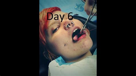 Tongue Split Day 6 YouTube