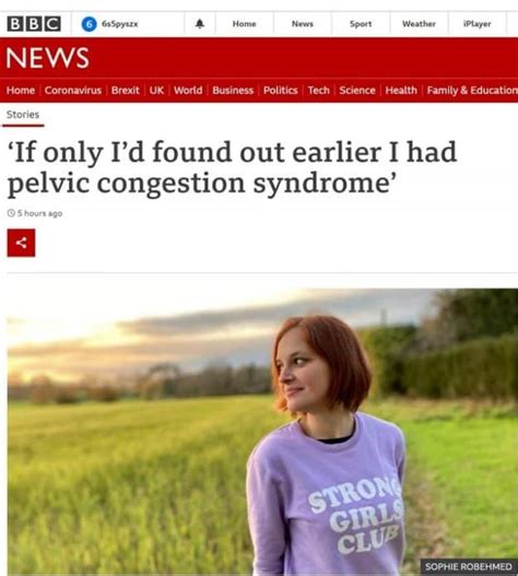 Pelvic Congestion Syndrome Featured On Bbc The Whiteley Clinic