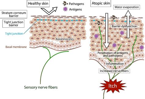 Schematic Representation Of The Pathogenesis Of Itch In Atopic