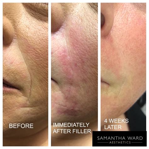 Hyaluronic Acid Based Dermal Fillers Whats Not To Love Samantha Ward Aesthetics