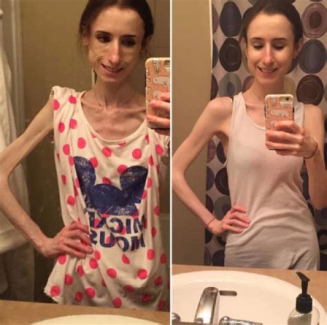 Las Sorprendentes Imágenes De Personas Que Le Ganaron A La Anorexia