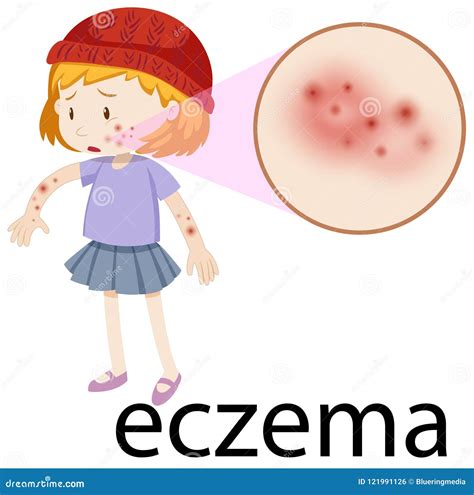 Young Child With Magnified Eczema Stock Vector Illustration Of
