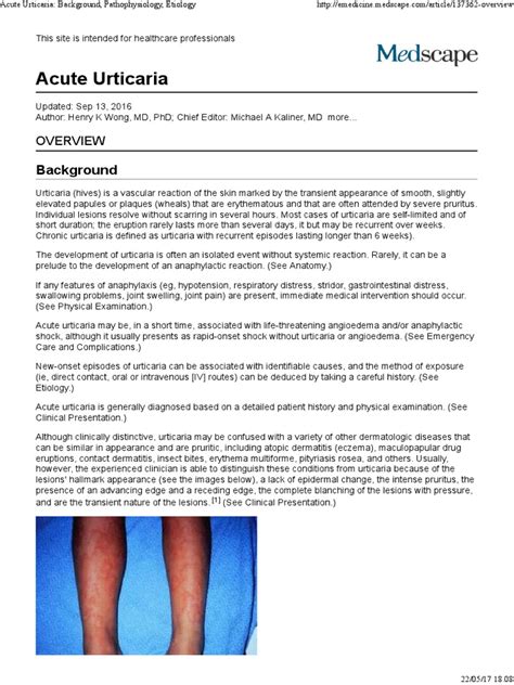 Acute Urticaria Background Pathophysiology Etiology Allergy