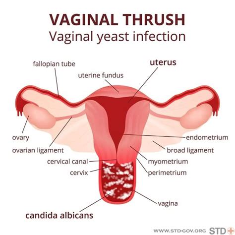yeast infections natural remedies angie s diary