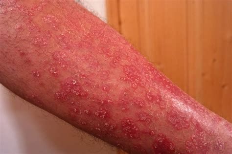 Penyakit Psoriasis Punca Simptom Dan Rawatan