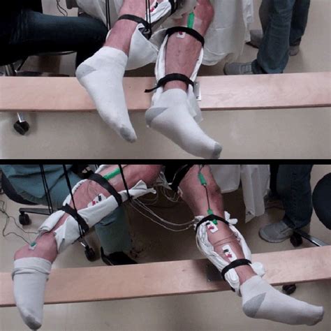 Non Surgical Approach Helps People With Paralysis Move Their Legs