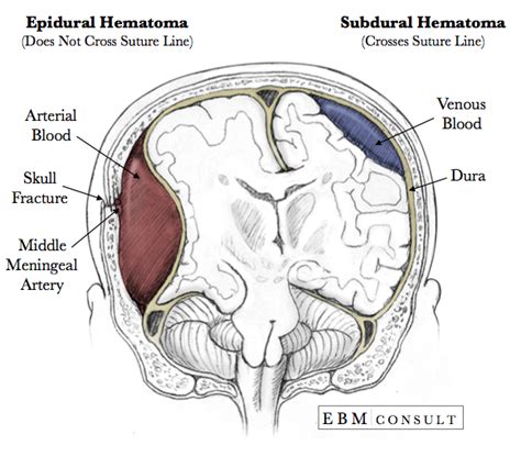 These pictures of this page are about:epidural and subdural hematoma. Anatomy: Epidural vs Subdural Hematoma Image