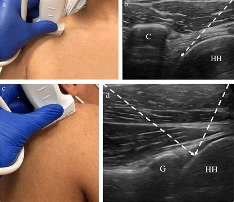 Ultrasound Guided Injection For The Glenohumeral Joint Notes A My Xxx Hot Girl