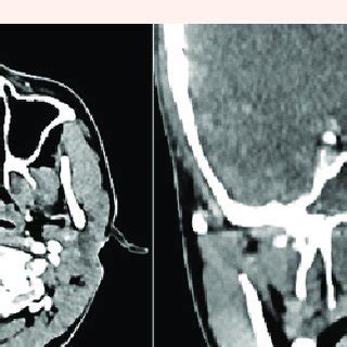 Fibroepithelial Polyp Of Vagina With A Fibrovascular Stroma Containing