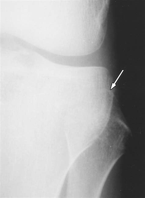 Avulsion Fracture Of The Head Of The Fibula The “arcuate” Sign Mr