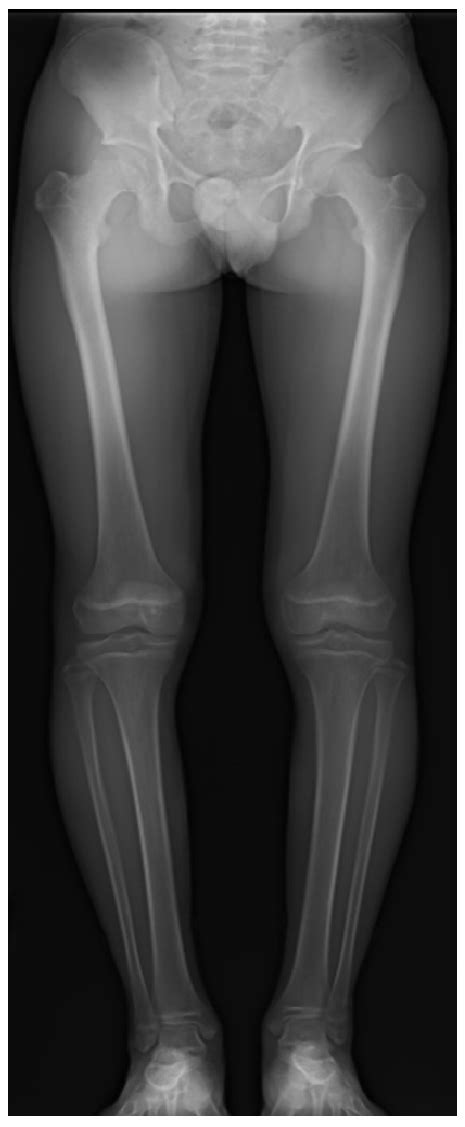 Ful L Leng Th F Rontal Plain Radiographs Of Lower Extremities Both