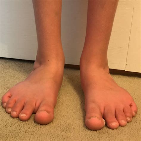Flat Feet – Care For Feet