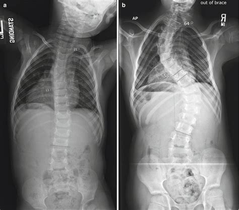 Apical Control In The Management Of Severe Early Onset Scoliosis Neupsy Key