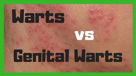 what s the difference between warts and genital warts youtube